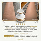 GLOVRÉ™ – Cellulite-Behandlung